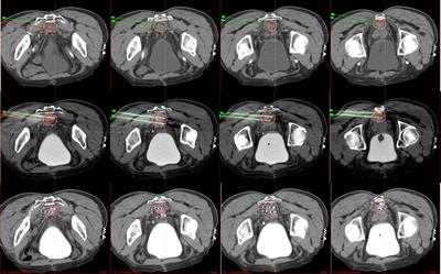 Long-Term Outcomes and Prognostic Analysis of Computed Tomography-Guided Radioactive 125I Seed Implantation for Locally Recurrent Rectal Cancer After External Beam Radiotherapy or Surgery